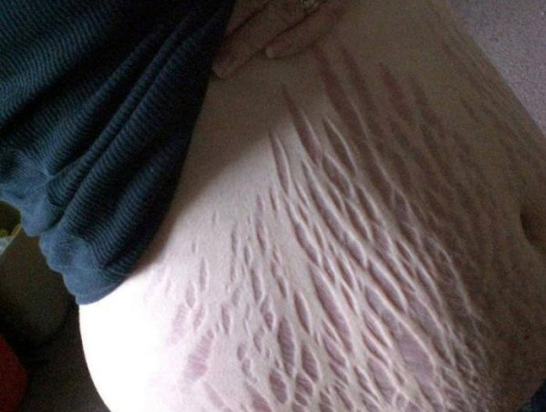 Stretch Marks Everything You Need To Know Man V Fat