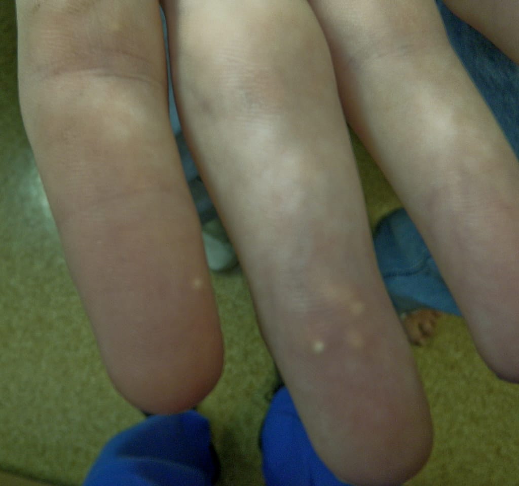 fingers showing tophi as a result of gout
